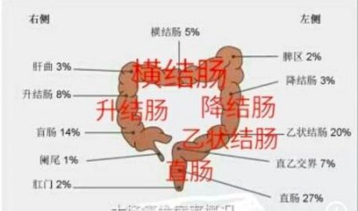 ​什么是肠道癌前病变(大肠癌的癌前病变是什么)