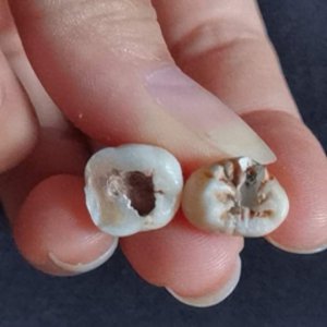 ​拔掉智齿要多长时间 拔智齿过程多久时间