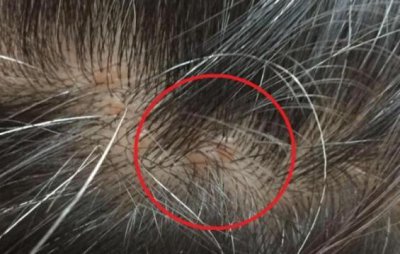 ​藏在头发里硬硬的“小疙瘩”是什么？再忙也要看一眼