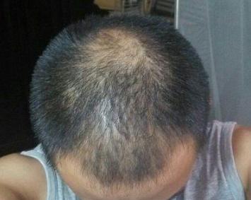 藏在头发里硬硬的“小疙瘩”是什么？再忙也要看一眼