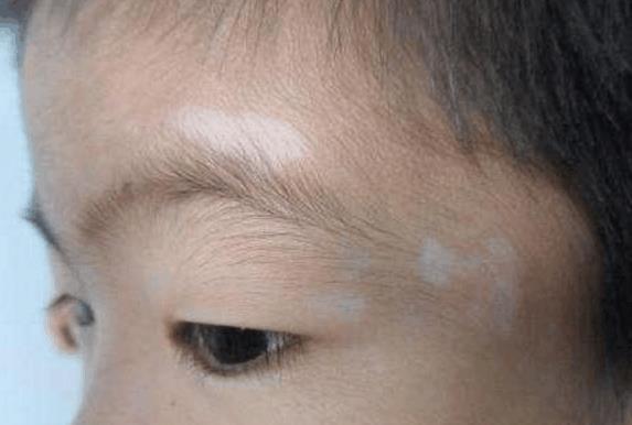 父母们要注意, 孩子出现这5种症状说明孩子肚子里有蛔虫!