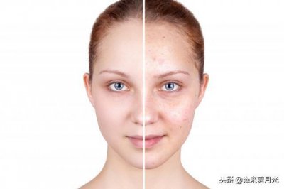 ​盘点痘痘和闭口的区别 凹凸不平的皮肤