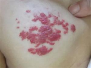 血管瘤有哪些症状表现？几张图来告诉你