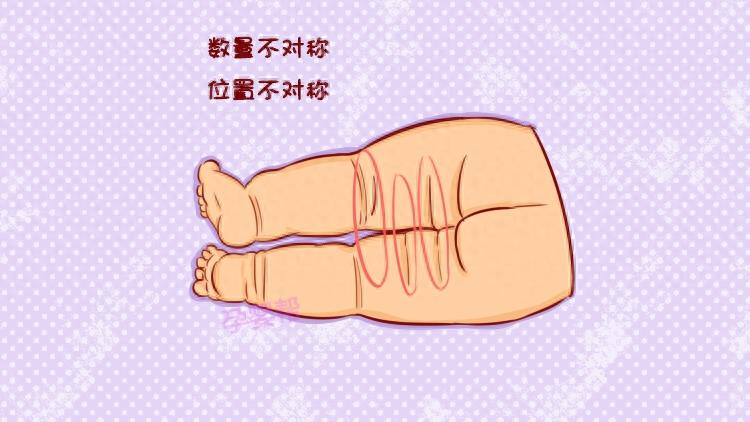 不知道怎样看宝宝腿纹是否对称？2种简单方法教给你
