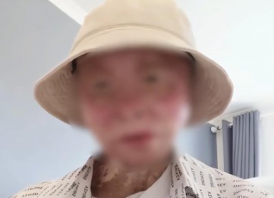 ​四川24岁女孩烧伤928天后重生，全脸毁容永失双手：不幸中的万幸