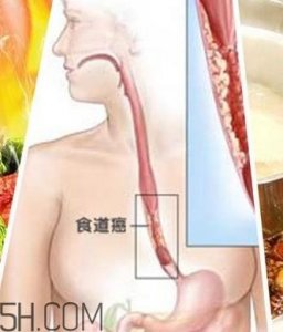 ​吃太烫会得癌？烫食不仅对胃不好还容易得癌