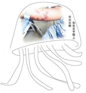 ​警惕！偏僻海边游泳，手臂被水母蜇伤