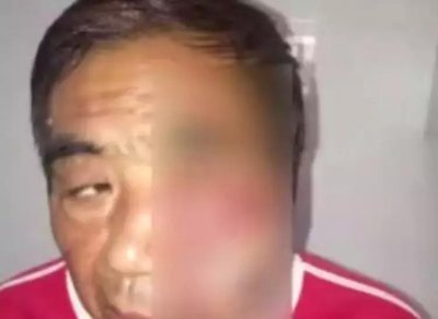 ​男子度假遭蚊虫叮咬面部，流脓淌血一个月，医生称可能危及生命
