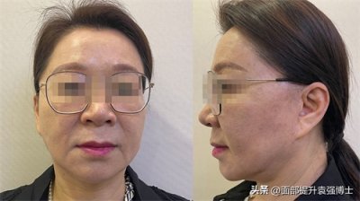 ​拉皮手术就是智商税？53岁做过两次拉皮，亲身经历给大家提个醒！